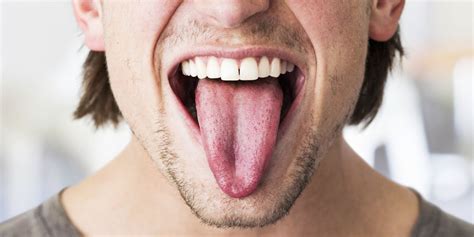 Tongue Symptoms Of Hiv In Men Acute Infection With Hiv 1 In A Male