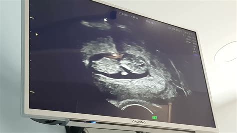 Baby Heartbeat Inside The Womb Youtube