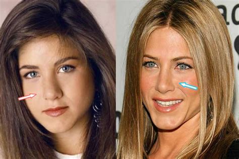 Jennifer Aniston Plastic Surgery Nose Job Boob Job Botox