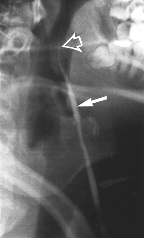 Fluoroscopic Diagnosis Of A Second Branchial Cleft Fistula Ajr