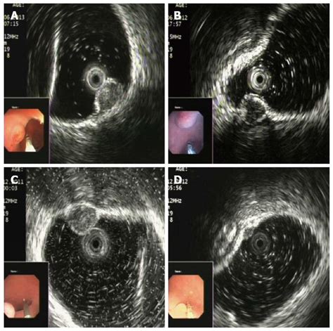 Diagnostic Accuracy Of Endoscopic Ultrasonography For Rectal