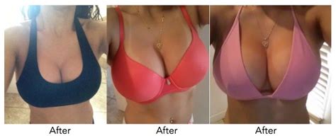 Breast Augmentation Breast Implant Breast Specialist Las Vegas