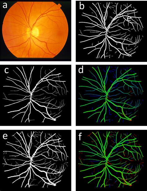 Overview Of Vessel Segmentation Process A Original Rgb Retinal