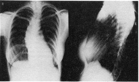 Postero Anterior Left And Left Lateral Right Chest Radiographs