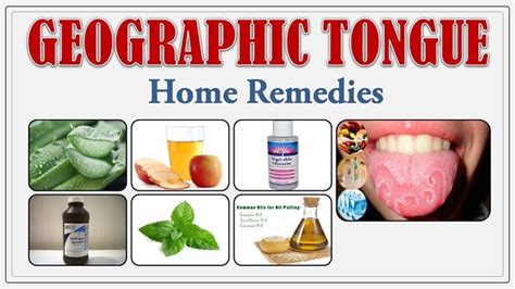 Geographic Tongue Symptoms Causes And Treatment Dentist Ahmed