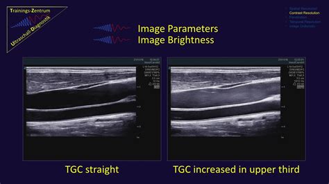 Contrast Resolution In Ultrasound Diagnostic 01 Youtube