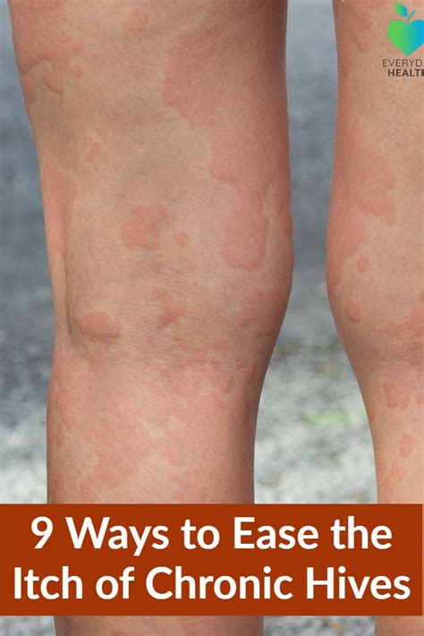 Hives On Skin Picture Of Hives Urticaria Hives Occur When Something