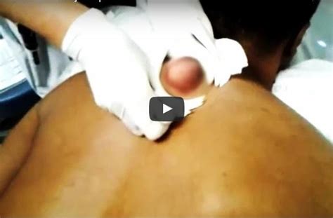 Glorious Back Cyst Explodes Viral On The Web Now