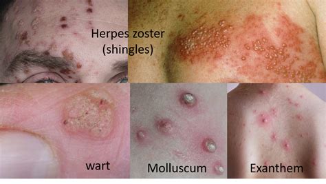 Skin Infections Types Predisposing Factors And Health Measures