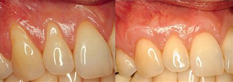 Estética Gingival Clínica Dental Qb