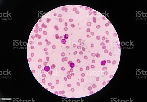 Blast Cells In Leukemia Stock Photo Download Image Now Istock