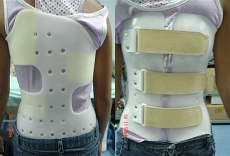 Can A Scoliosis Brace Help With Adolescent Idiopathic Scoliosis