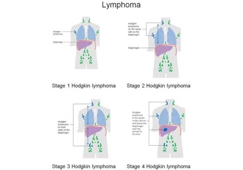 Lymphoma Hodgkin And Non Hodgkin Symptoms Stages Treatments