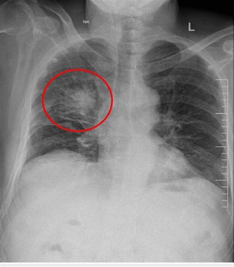 Chest X Ray Pa View Showing An Ill Defined Spiculated Opacity In The