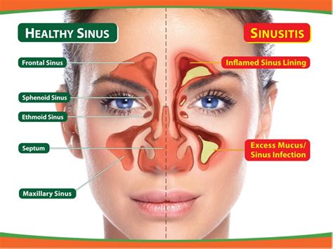 Toothache Or Sinus By Dr Lee Lichtenstein Dr Lee Lichtenstein