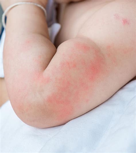 Hives On Baby Causes Symptoms Treatment And Prevention