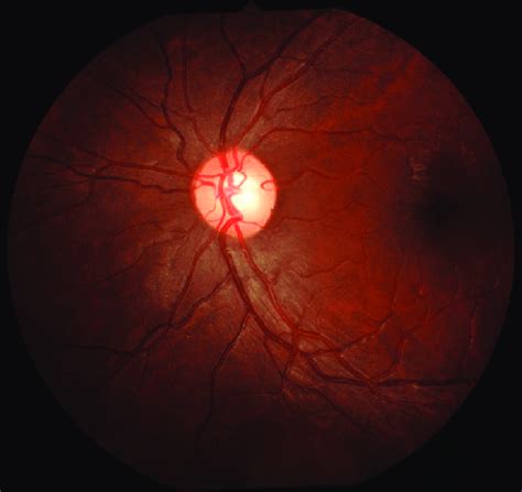 Fundus Photograph Os Showing Dull Foveal Reflex After 1 Month Figure 4