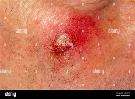 Boil On Cheek A Red Inflamed And Pus Filled Boil Furuncle Seen On