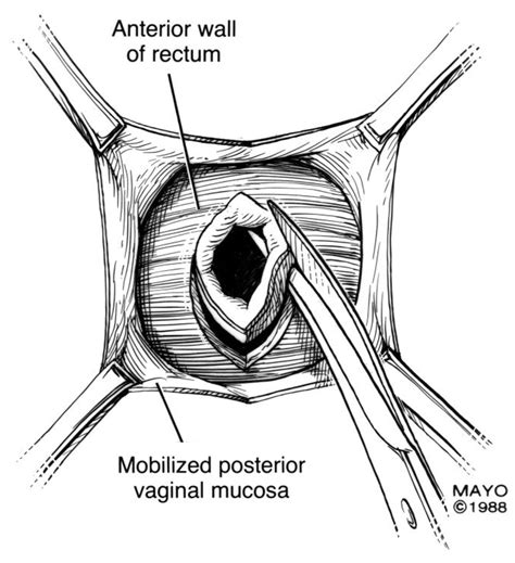 Rectovaginal Fistula Discharge
