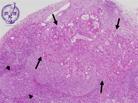 2lymph Node 9 Cancer Metastasis Into The Lymph Nodespathology Core