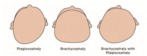 Plagiocephaly And Brachycephaly When Babies Have A Flat Head