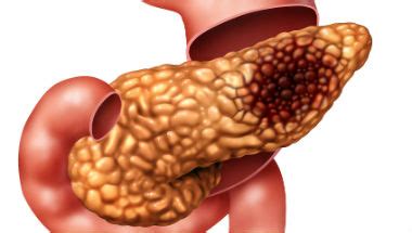 Pancreatic cancer symptoms to take seriously. Pancreatic cancer patients should be offered early scans ...