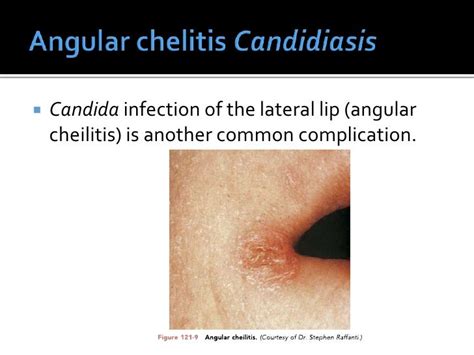 1 1 Oral Candidiasis