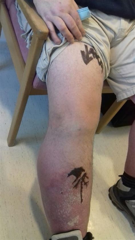 Dad Had To Have Leg Amputated After He Was Bitten By False Widow Spider