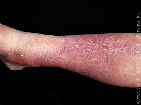 Dermatitis On Legs Pictures Photos