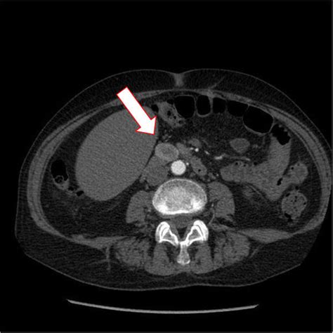 Procedure For Ct Scan Of Abdomen With Contrast Ct Scan