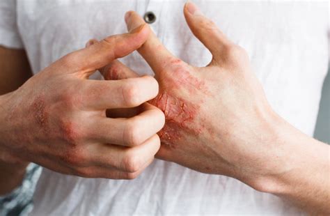 The Cure For Eczema Is Likely More Than Skin Deep Discover Magazine