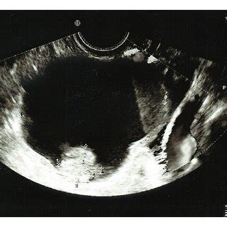 Ovarian cyst pelvic ultrasound female. Pelvic ultrasound, showing a large complex ovarian cyst ...