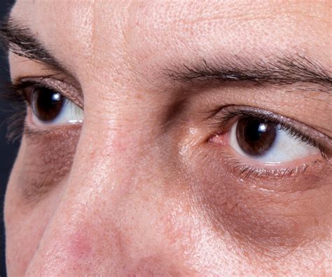 Treatment Of Dark Under Eye Circles In New York City Park Avenue Skin