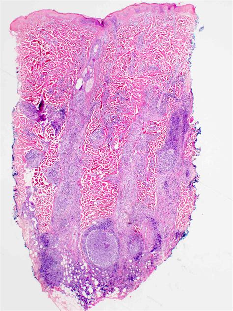 Pathology Outlines Primary Cutaneous Follicle Center Lymphoma