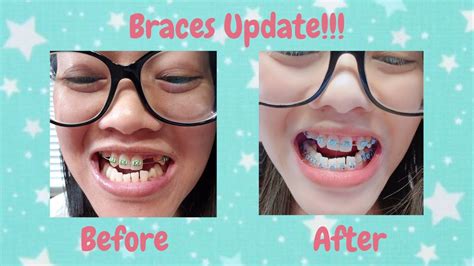 adult braces new update pontic tooth bottom braces youtube