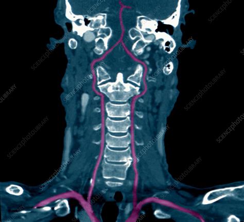 Neck Arteries And Spine Ct Angiogram Stock Image C0370787