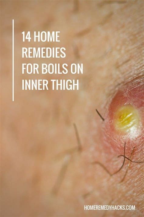 14 Proven Home Remedies For Boils On Inner Thigh Home Remedy For Boils Home Remedies Get Rid