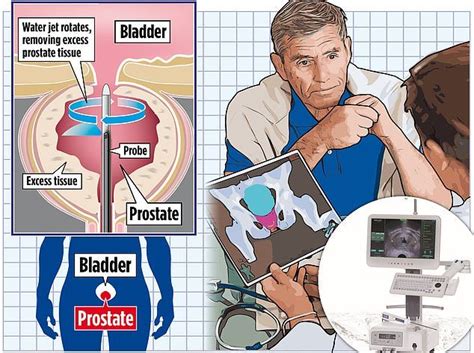 Water Jet Procedure To Shrink Enlarged Prostates Will Be Offered To Thousands Of Male Patients