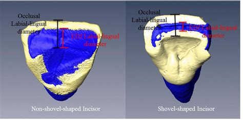 Shovel Shaped Incisors And The Morphology Of The Enamel Dentin Junction