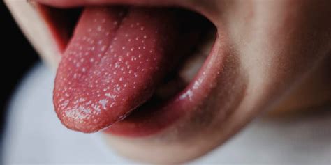 How To Get Rid Of Bumps On Tongue Lordunit28