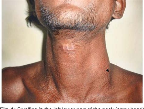 Figure 1 From An Unusual Case Of Bull Gore Injury To The Neck