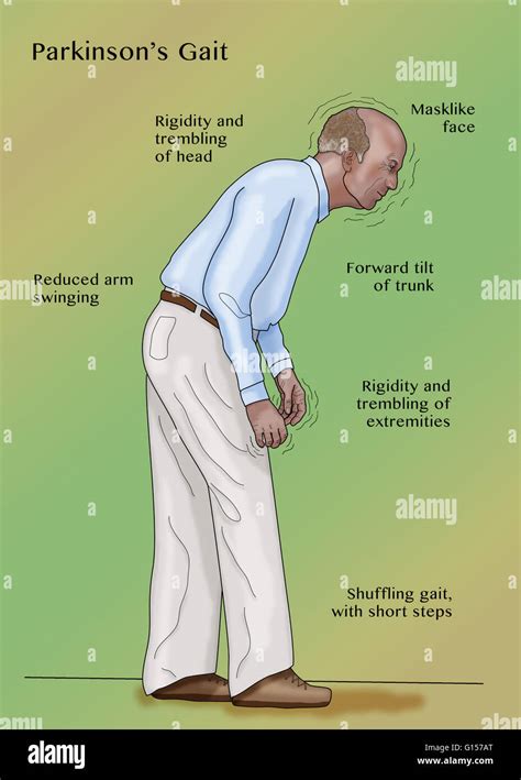 Illustration Of A Man With Parkinsons Disease Parkinsons Is A Stock