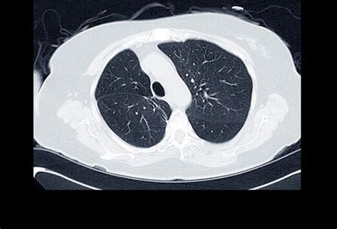 Vier F Lle Zu Lungenkrebs Medscape Deutschland