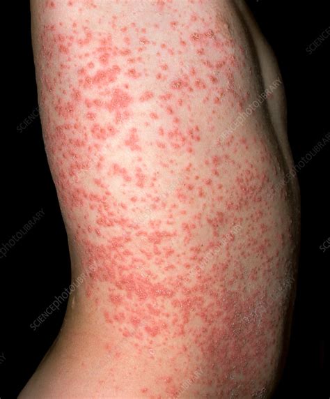 Guttate Psoriasis Stock Image C0372747 Science Photo Library