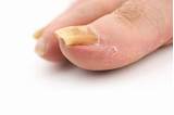 Images of Nail Psoriasis Treatment Options