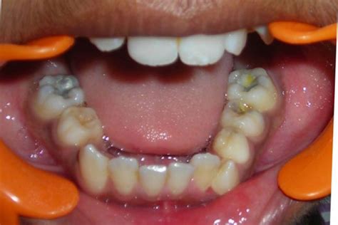 Non Syndromic Multiple Supernumerary Teeth Report Of A Case With 13
