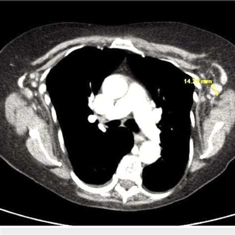 Chest Ct Showing Bilateral Axillary Lymphadenopathy And Enlarged