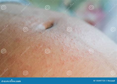 Irritated Skin During Pregnancy Stock Image Image Of Rash Patient
