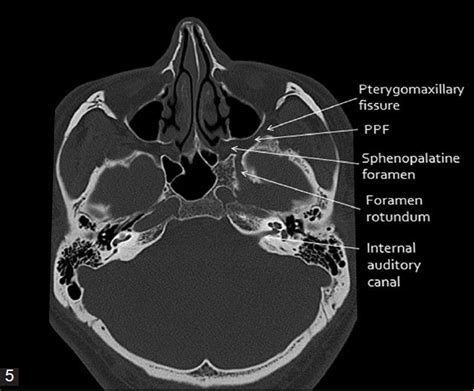 Axial Ct Bone Window Of Skull Base From Inferior To Superior Aspect