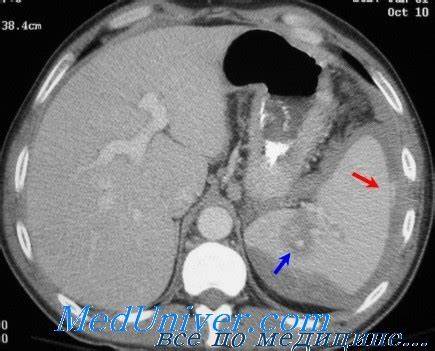 Диета при отсутствие селезенки